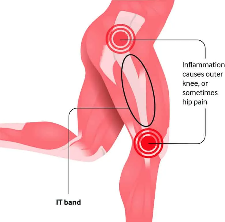 Lesiones más comunes en el running y como evitarlas 3 Trainercarles Lesiones más comunes en el running y como evitarlas